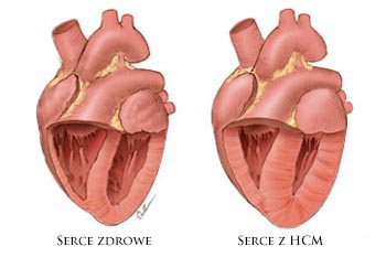 HCM Hearts